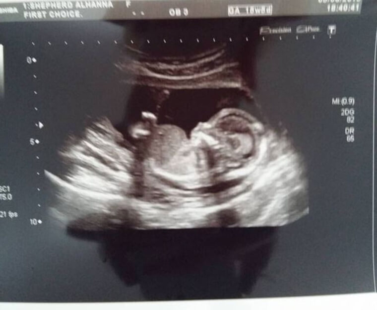 A Double Kidney Infection